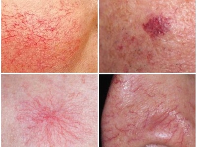 30 min session for removing skin impurities that may sit on the skin. Skin tags, Broken capillaries, keratosis, etc - Simply Smooth Aesthetics