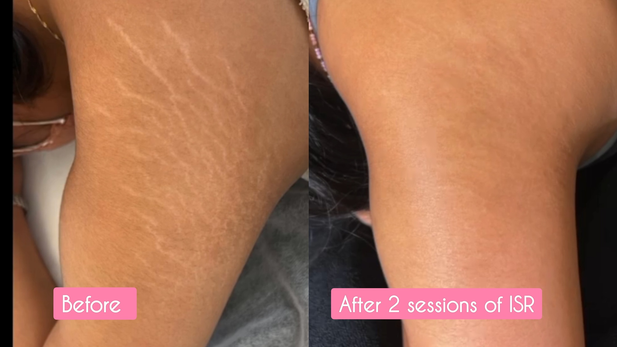 Inkless Stretch Mark Revision for All Body Sizes