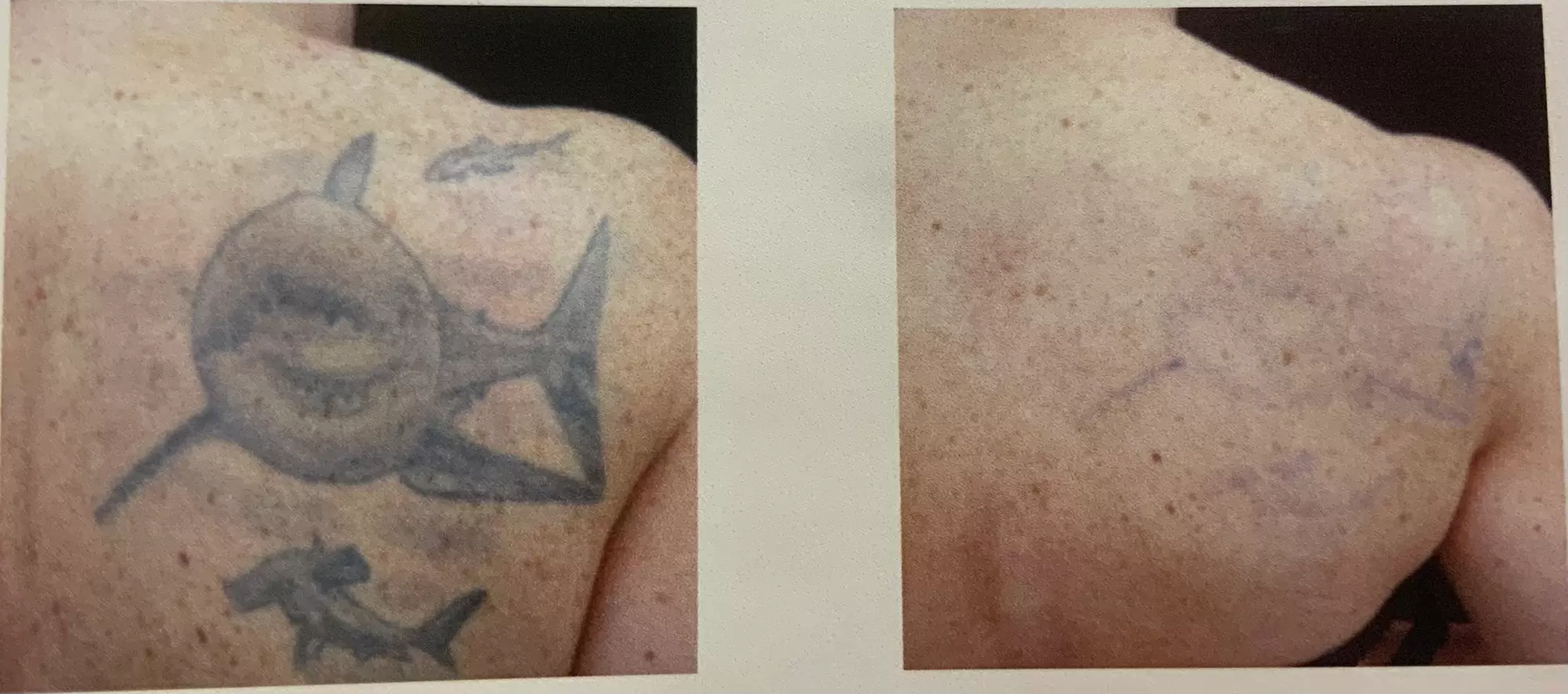 9-Session Laser Tattoo Removal for Areas Less than 1 in up to 88 Sq In