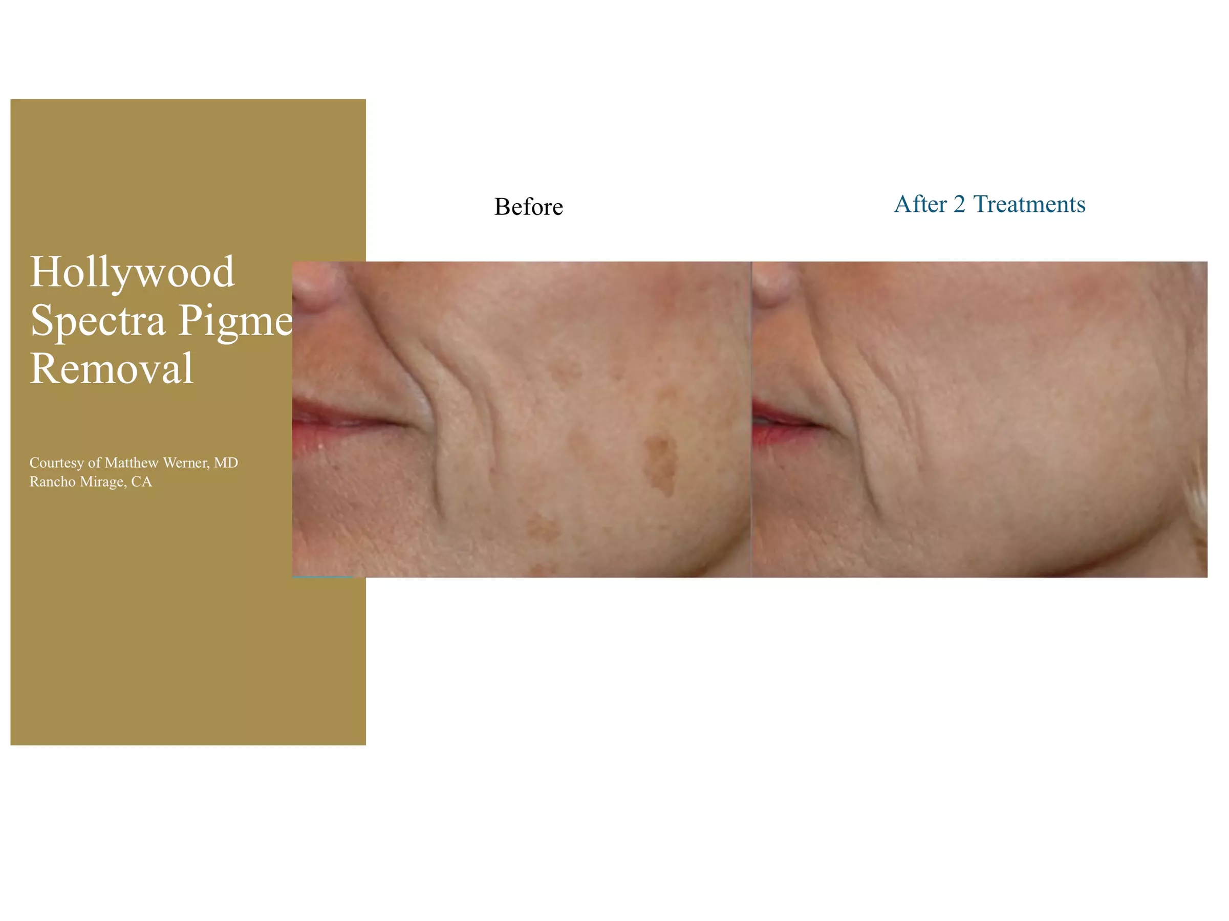 Up to 60% Off on Tattoo - Temporary at Surry Hills Laser & Cosmetic - Image 5