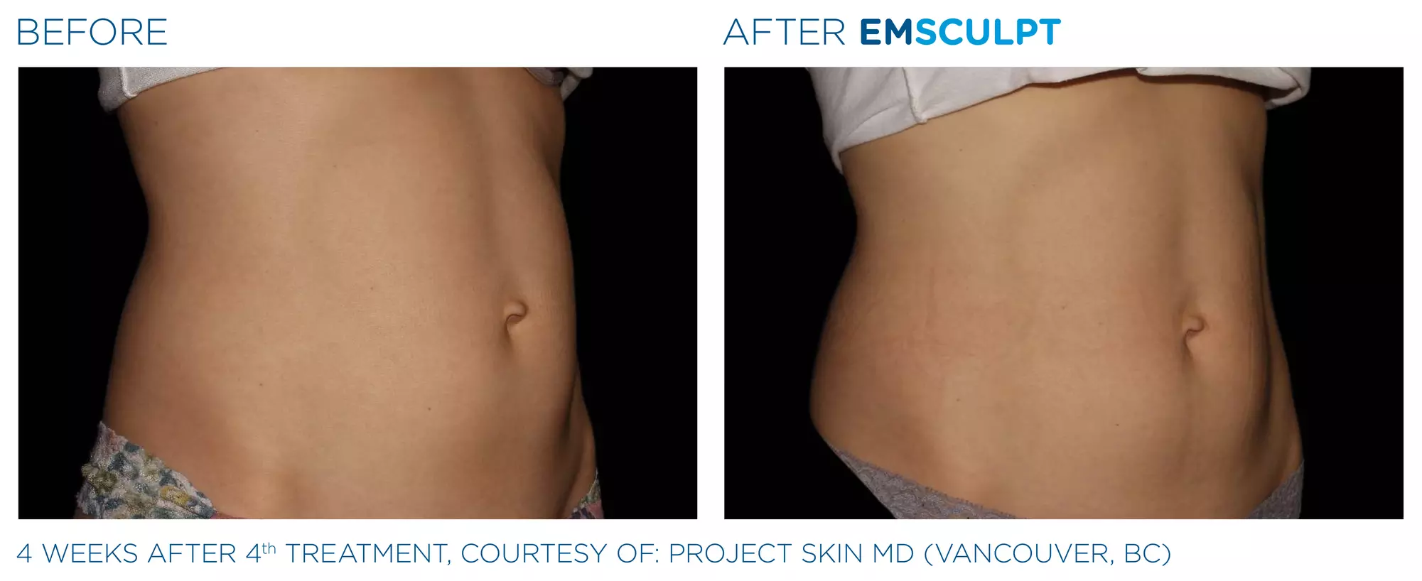 Strengthen & Tone Your Body with Two, Four, or Six Emsculpt Sessions