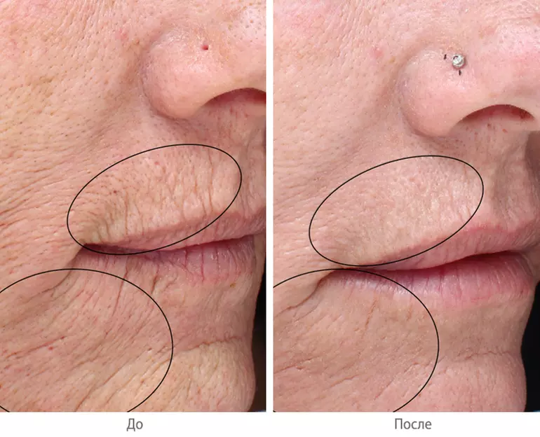 Up to 57% Off on Facial at Laser Center by Jana Bay - Primary Image