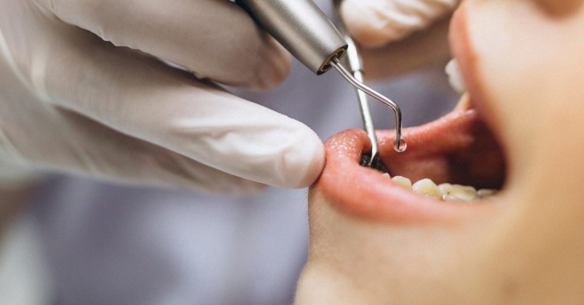 Examen dental con limpieza ultrasónica y revisión en Madrid