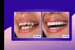 Achieve a Radiant Smile with Custom Professional Teeth Whitening Treatment at StarSmiles (Up to 33% Off) - Second Medium