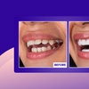 Image 6: Transform Your Smile with Custom Teeth Whitening