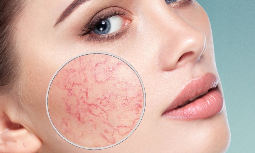 spider-vein-removal-define-groupon