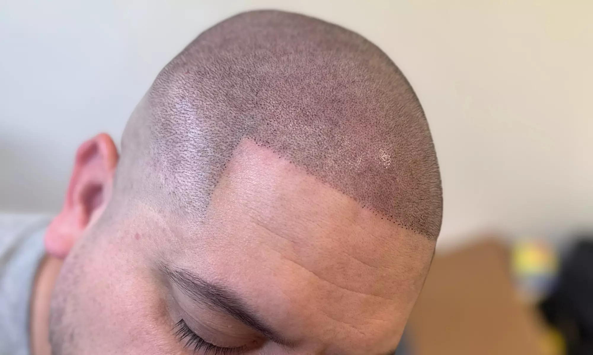 Up to 50% Off on Tattooing at Hairlines & Beyond Scalp Micropigmentation - Primary Image
