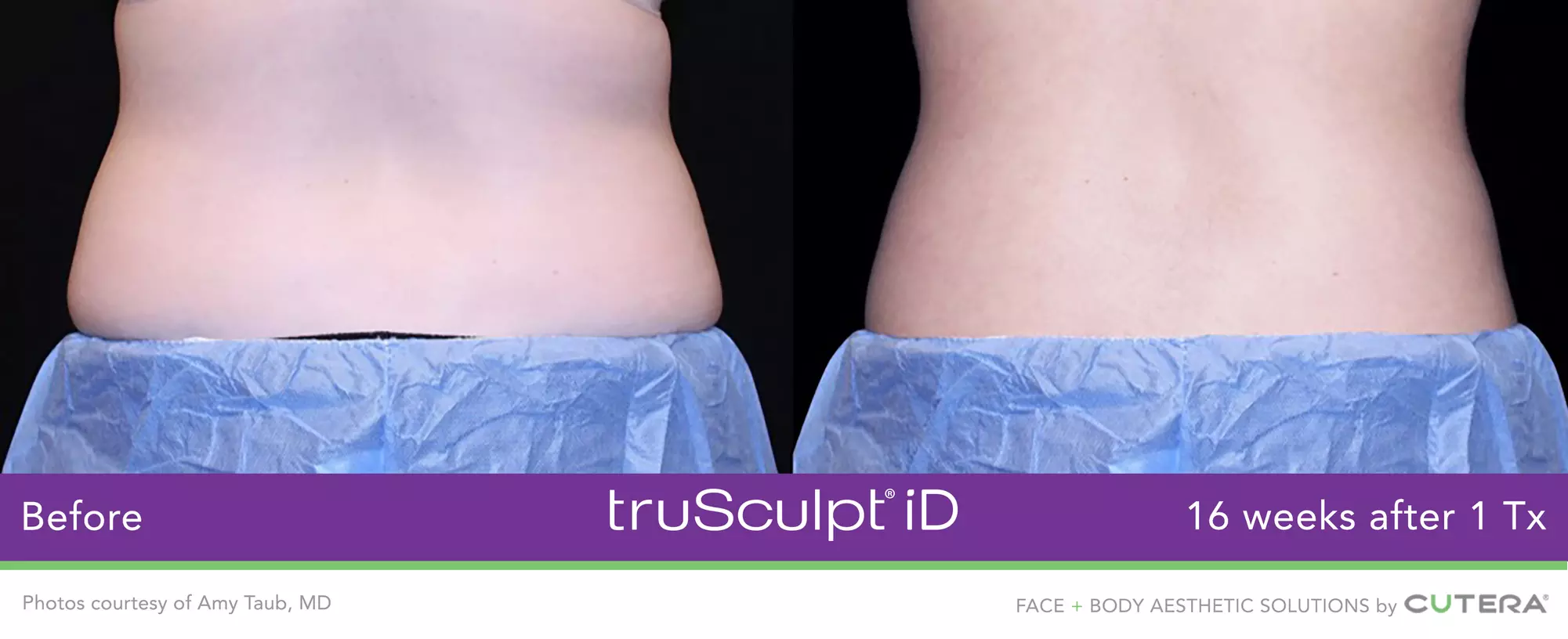 Experience Non-Invasive Fat Reduction with TruSculpt