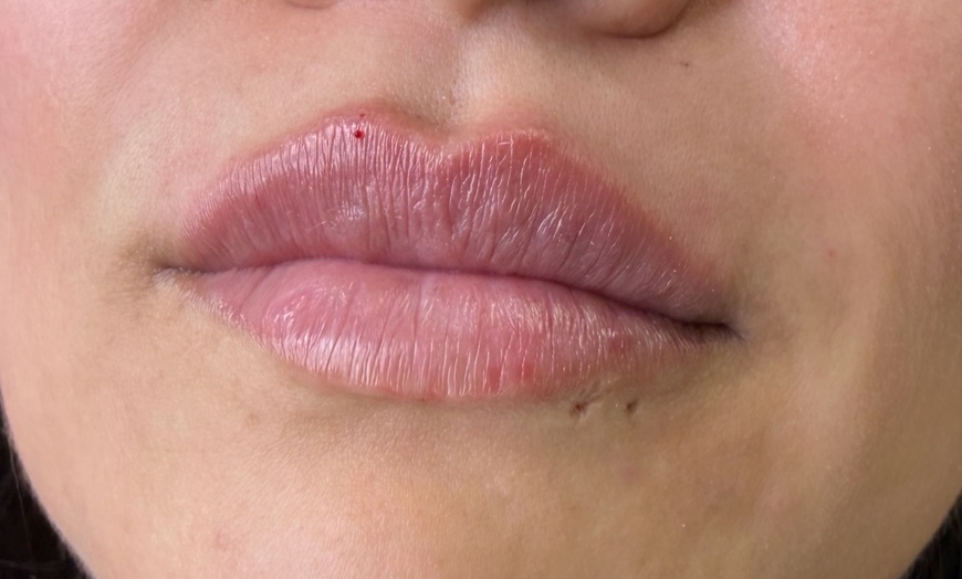 Image 5: Up to 40% Off on Injection - Botox at Skinn Loft