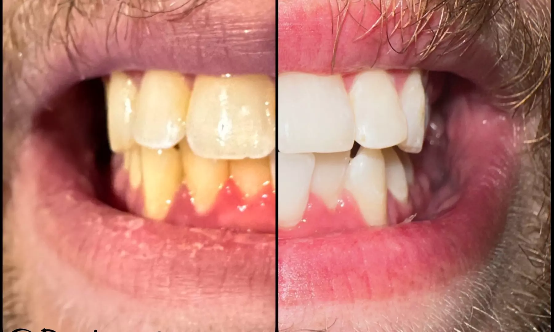 Up to 50% Off on Teeth Whitening at Rockin Smiles - Primary Image