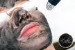 Laserowy peeling węglowy na twarz i szyję w Studio Wizażu i Stylizacji w Rzeszowie - Second Medium