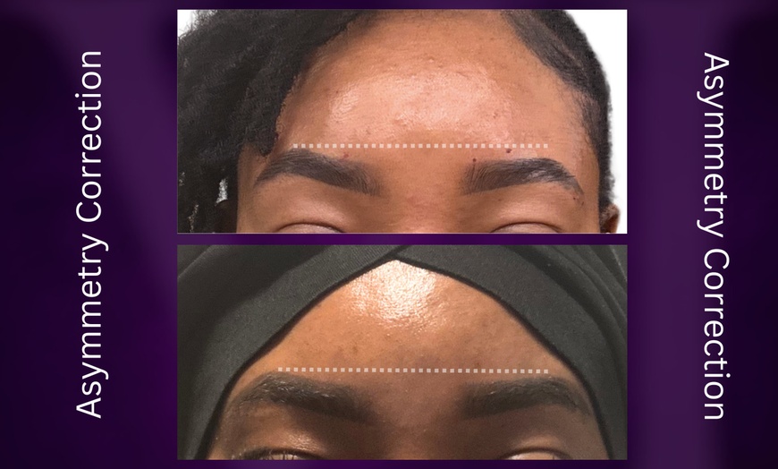 Image 6: Azzalure Skin Booster for Target Frown, Forehead & Eye Wrinkles 