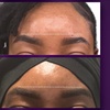 Image 6: Azzalure Skin Booster for Target Frown, Forehead & Eye Wrinkles 