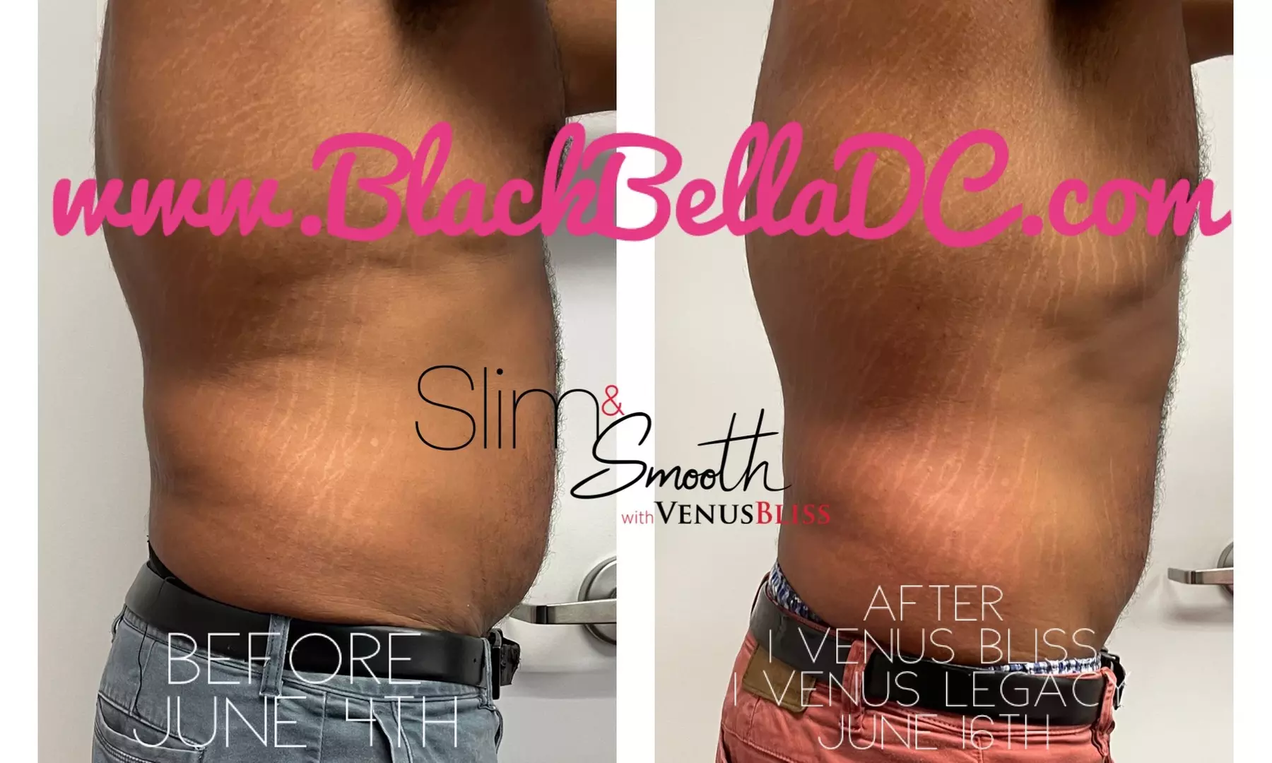 Discover the Power of Venus Bliss:  Laser Lipolysis Treatments at Black Bella Dc Body Sculpting (Up to 40% Off)