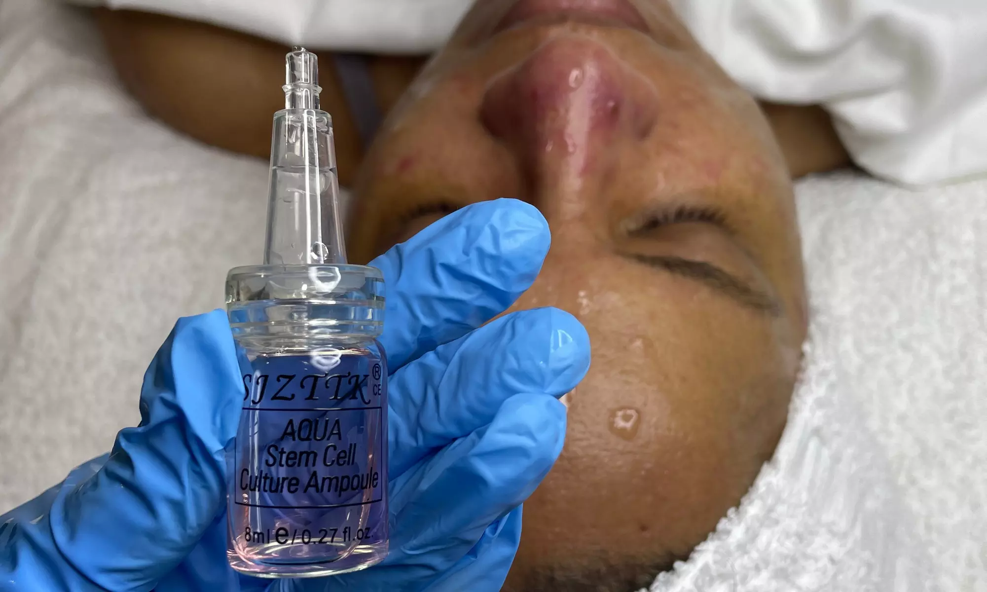 Enhance your skin's radiance with Revive Esthetic's Microdermabrasion Treatment, up to 50% off - Second Medium