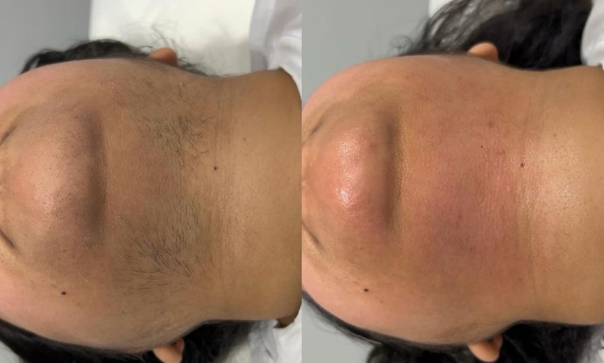 Image 3: 8 Laser Hair Removal Sessions on One Small, Medium, or Large Area (Up to 60%)