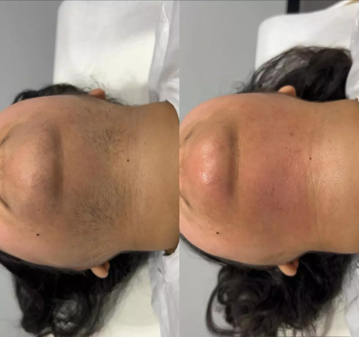 8 Laser Hair Removal Sessions on One Small, Medium, or Large Area (Up to 60%)