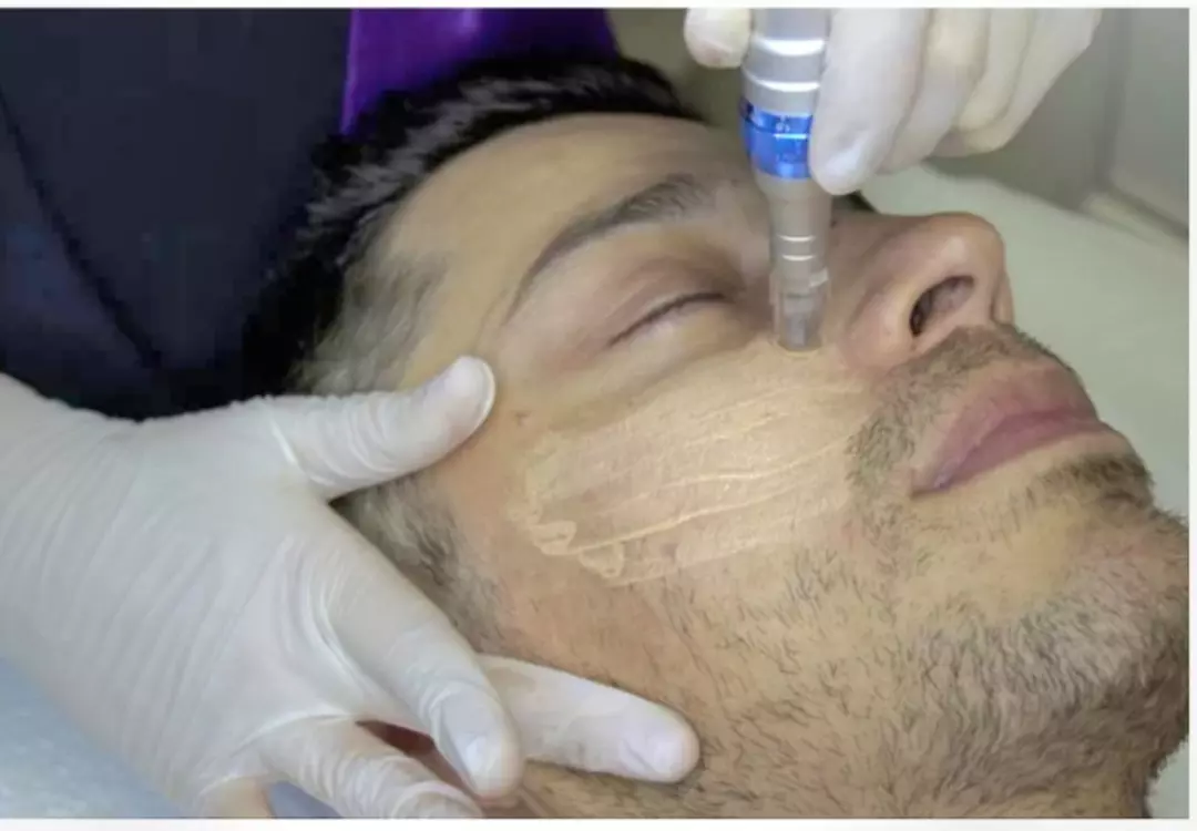Up to 52% Off on BB Glow Facial Treatment at My Face Place - Second Medium