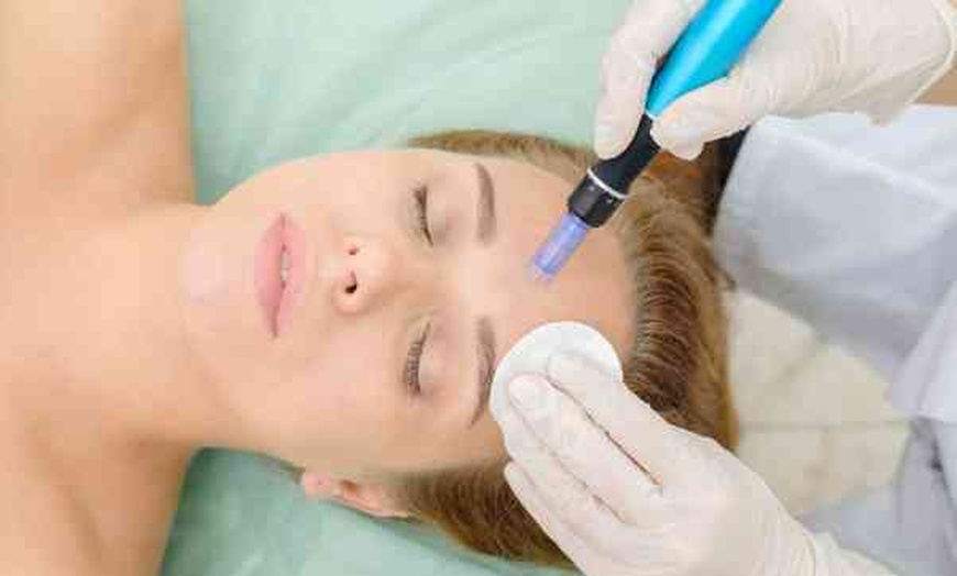 Image 3: Up to 37% Off on micro needling and advanced skin treatments