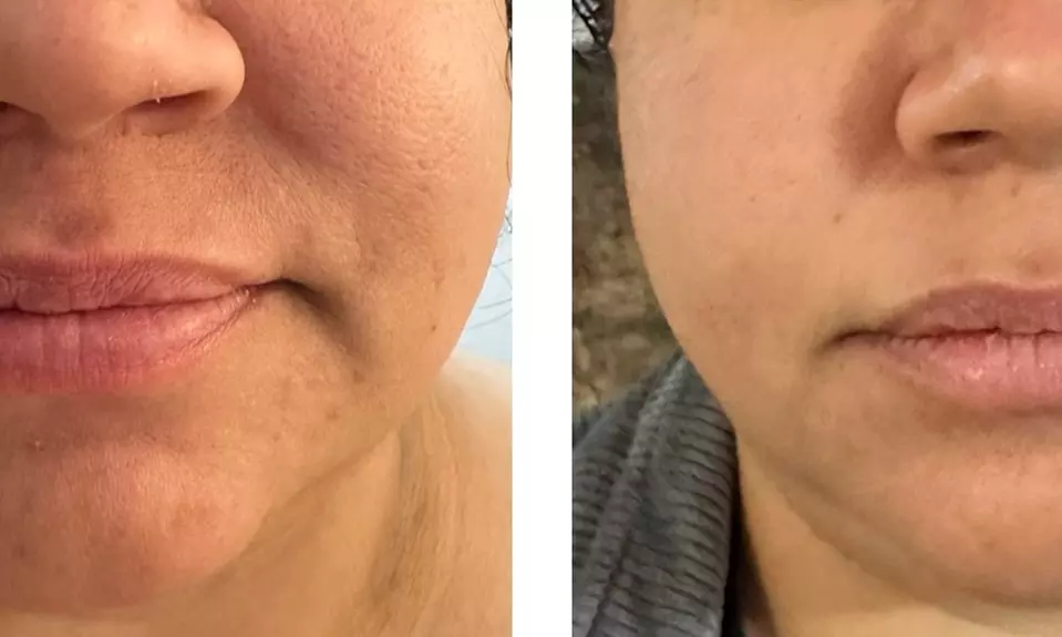 Up to 65% Off on Facelift - Non-Surgical at Velvet Vanity By Puja