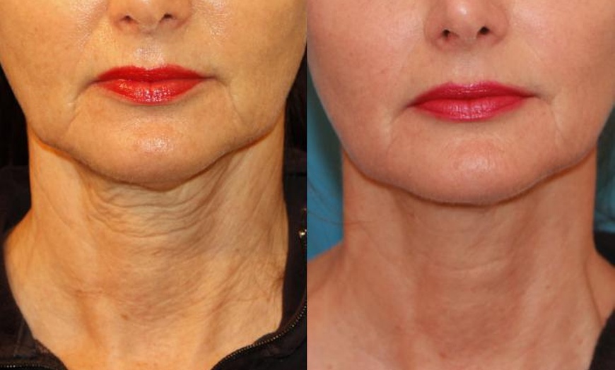 Image 3: Morpheus 8 Face and Neck / Abdomen or Butt Treatment at No Pain All Gain Spa (Up to 37% Off)