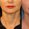 Image 3: Morpheus 8 Face and Neck / Abdomen or Butt Treatment at No Pain All Gain Spa (Up to 37% Off)