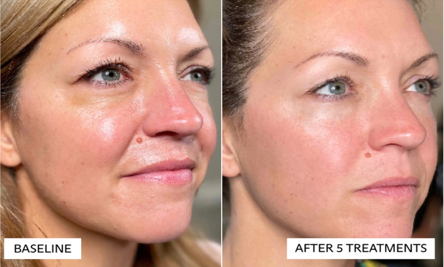 Image 1: TriLift Non Surgical Facelift or Radio Frequency Facial 