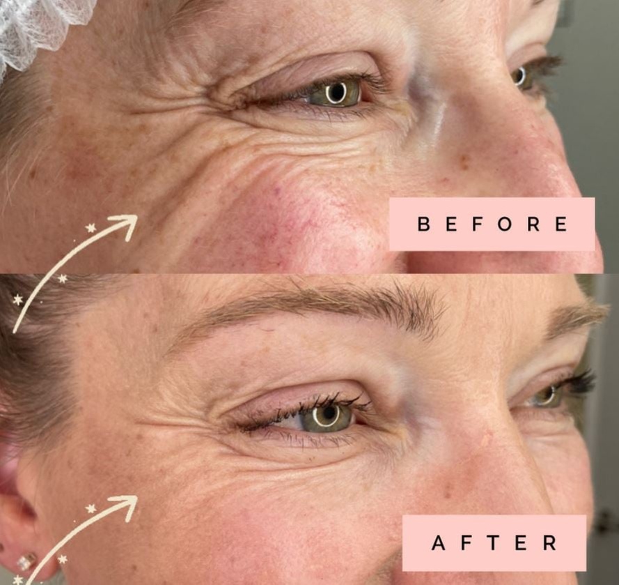 Transform Your Look: Plasma Fibroblast Treatment
