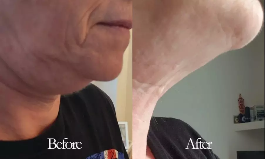 Up to 50% Off on Fat / Cellulite Reduction - Non-Branded at Noire Aesthetics