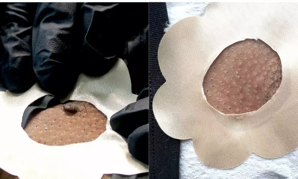 One-Three, Four-Six, and Seven-Nine Skin Tag Removal