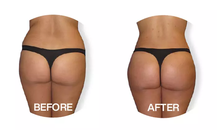 Up to 55% Off on Fat Reduction - Non-Branded at BLING K BEAUTY SPA - Second Medium