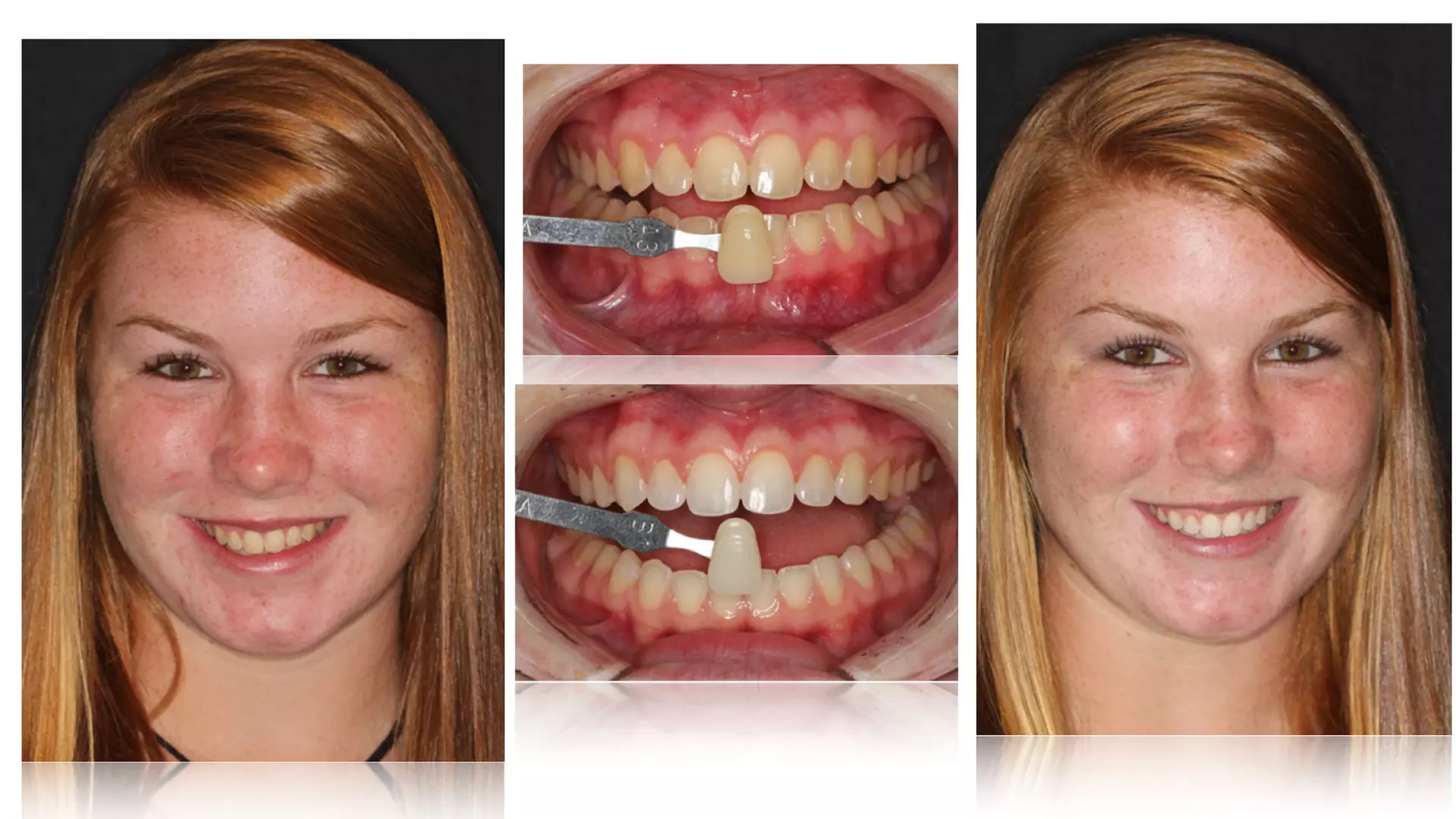Up to 62% Off on Teeth Whitening at The Whitening Shop - Second Medium