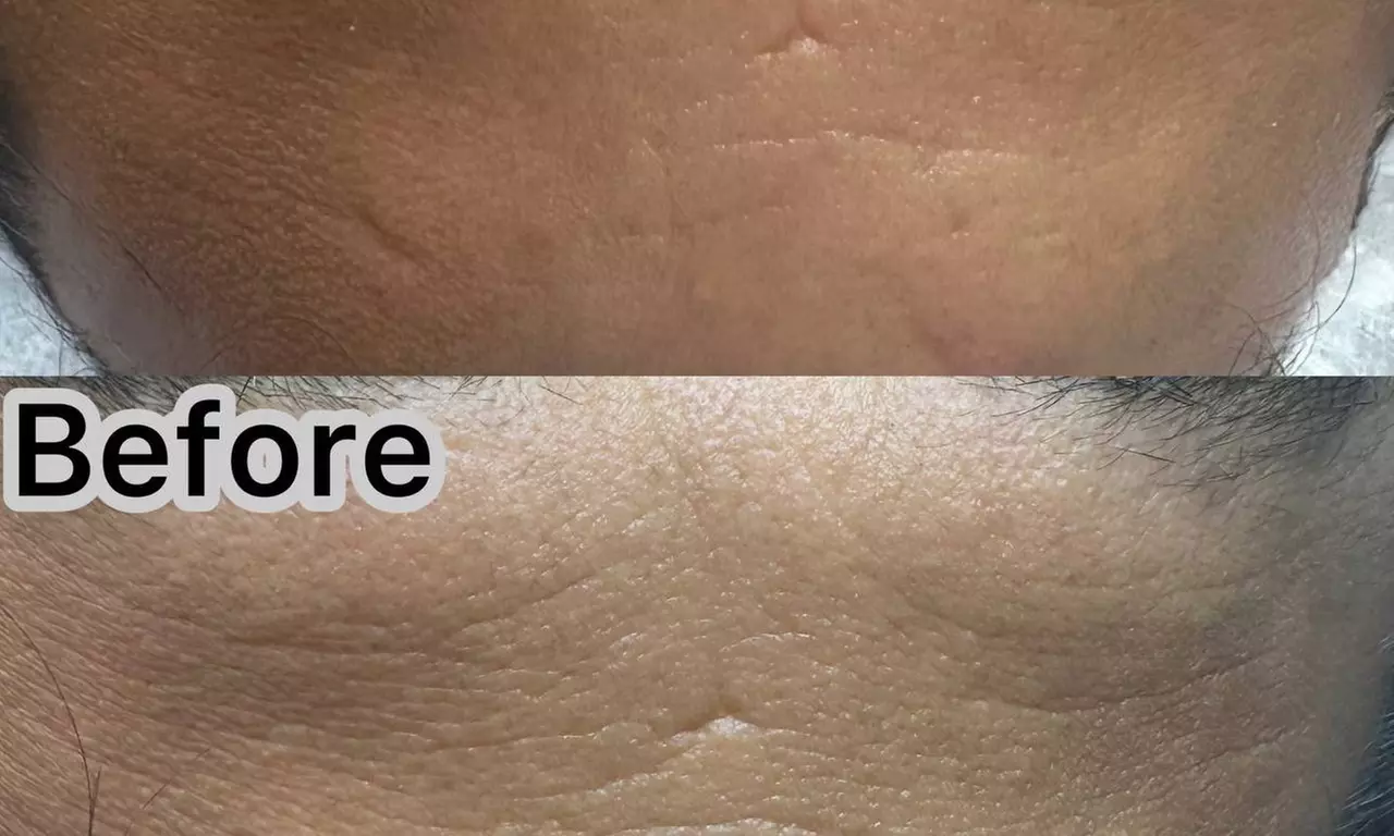 Up to 36% Off on HydraFacial