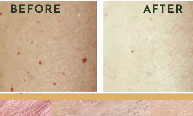 Experience Refined Renewal Day Spa's removal treatment for skin tags, sun spots, age spots, or milia with up to 50% off - Second Medium