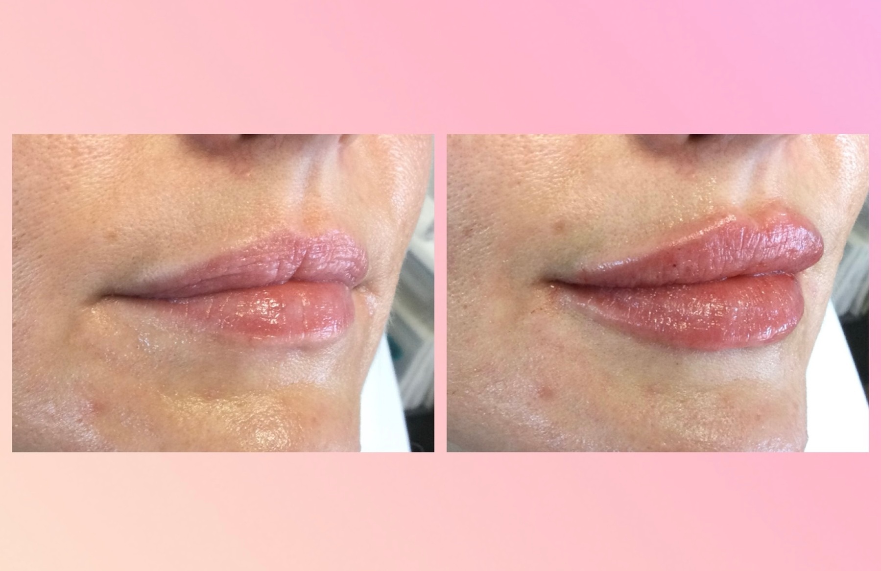 Up to 19% Off on Injection - Filler and Freezer at Elixir Medical Spa