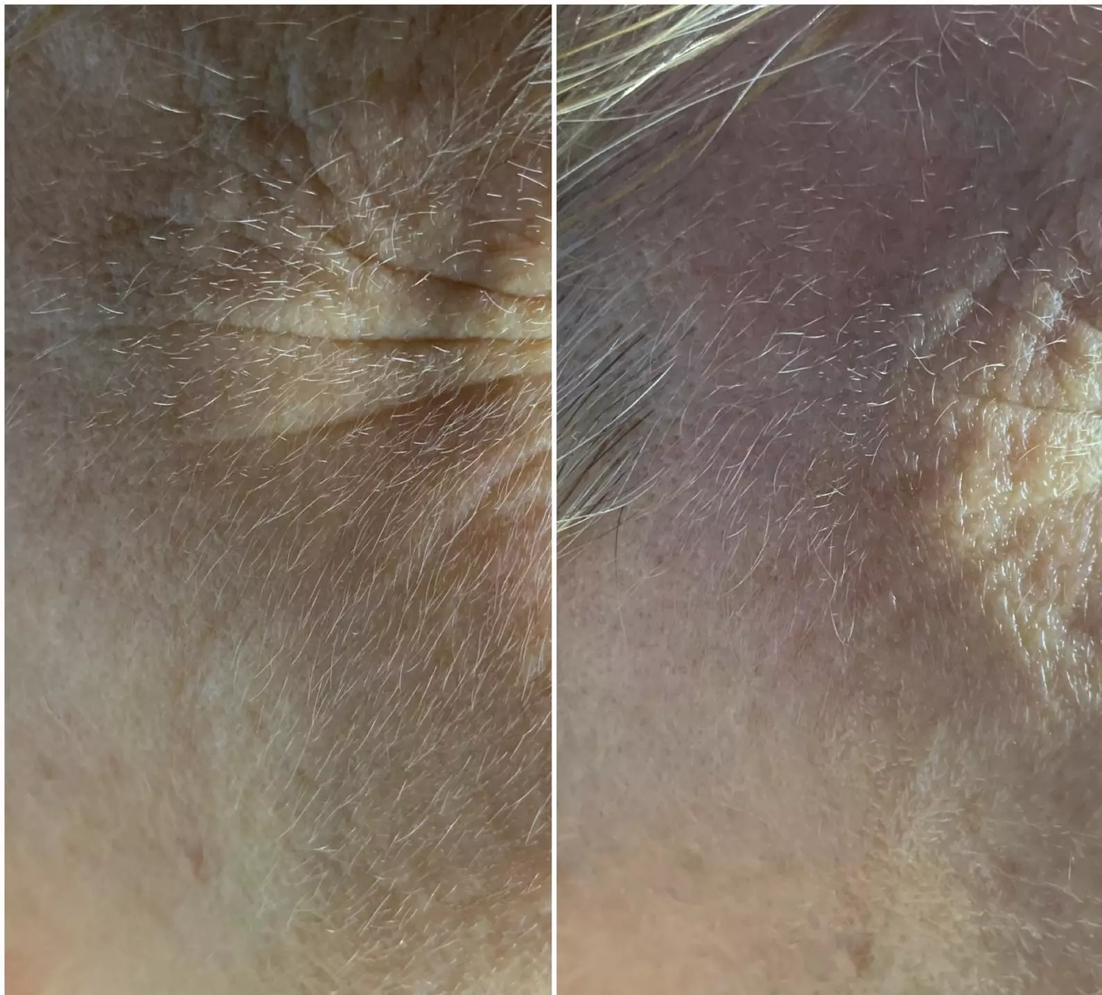 Achieve Radiant Skin with Zen Beauty Lounge's Facelift Options - Up to 50% Off - Second Medium