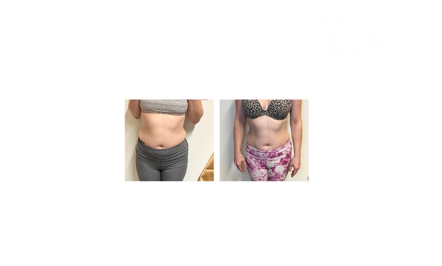 Image 1: Up to 58% Off on Fat Reduction - Non-Branded at Your Sculpt Studio