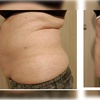 Image 12: Vivien laser do lipolizy tkanki tłuszczowej wybranych partii ciała