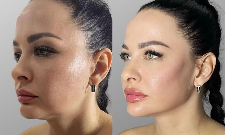 Image 4: Achieve a Youthful Glow with Dermal Fillers 