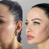 Image 4: Achieve a Youthful Glow with Dermal Fillers 