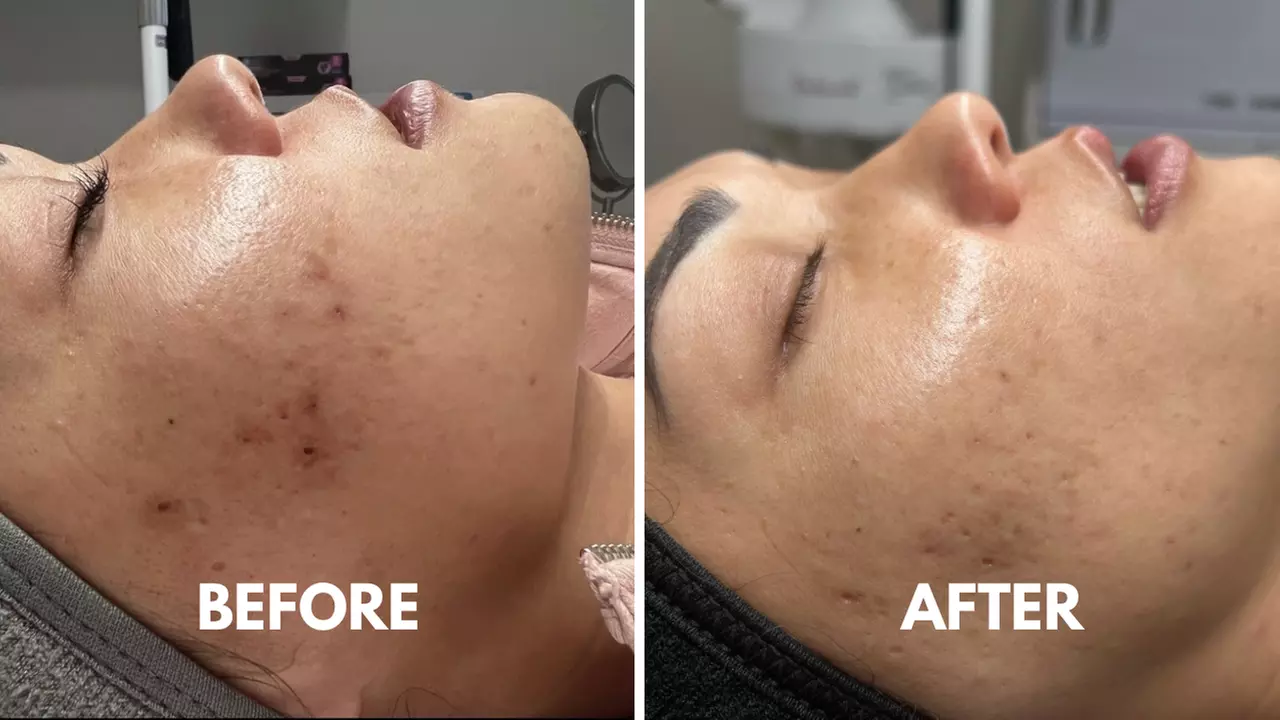 Experience One Facial and Acne Treatment Session for Fresh Skin at SkinTime Esthetics Corp. (Up to 54% Off) - Second Medium