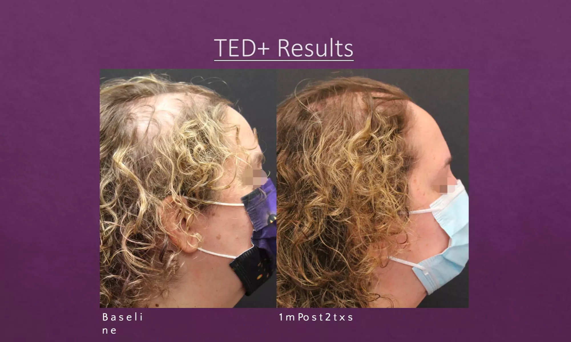 Up to 50% Off on Hair Restoration - Non-Surgical at HoustonOG - Primary Image