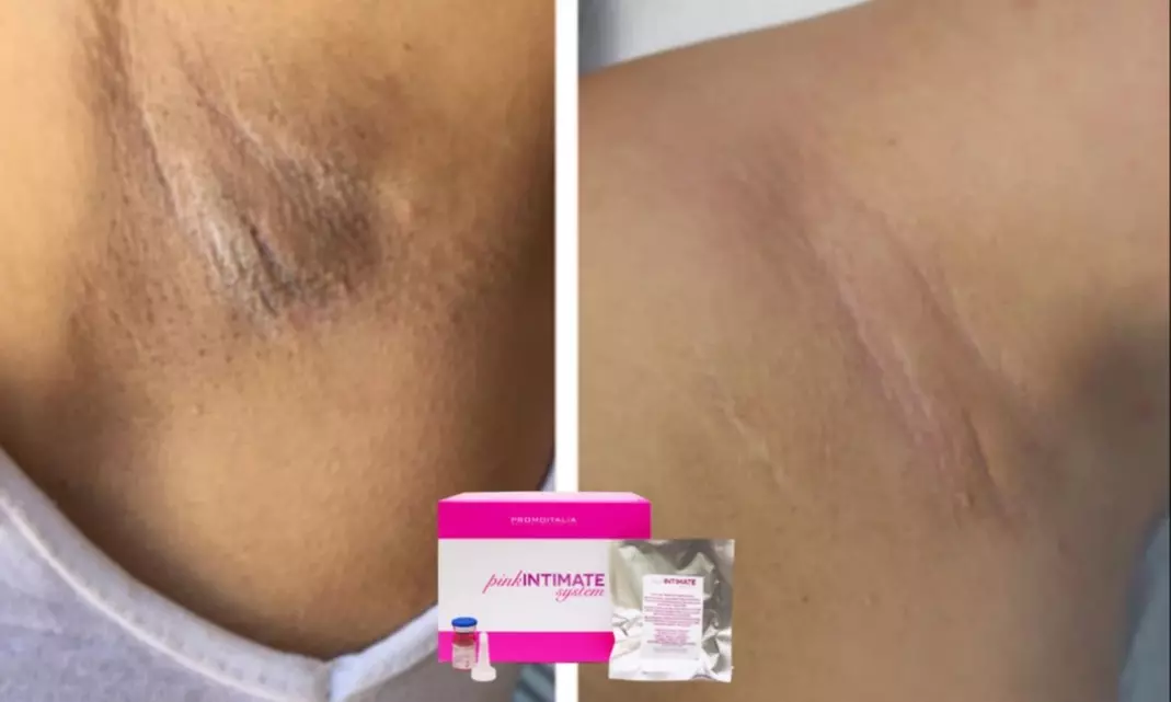 Up to 40% Off on Underarm Lightening at Gerald's Skinvantage - Primary Image