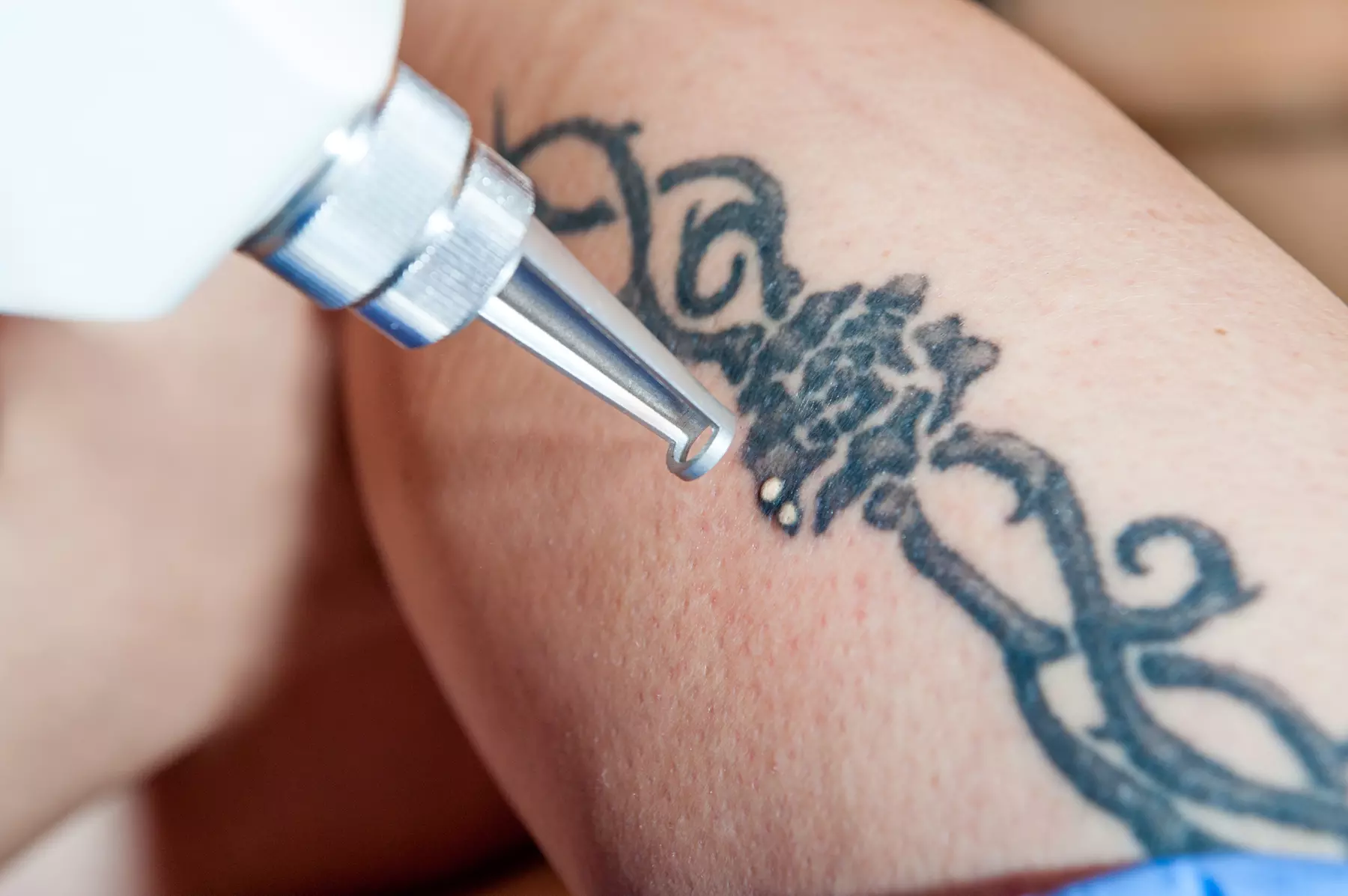 Up to 75% Off on Tattoo Removal at Tempe Laser Center