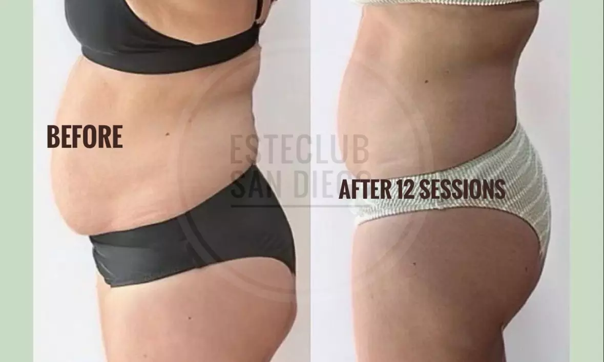 Up to 75% Off on Cellulite Reduction at Aesthetic Source - Second Medium