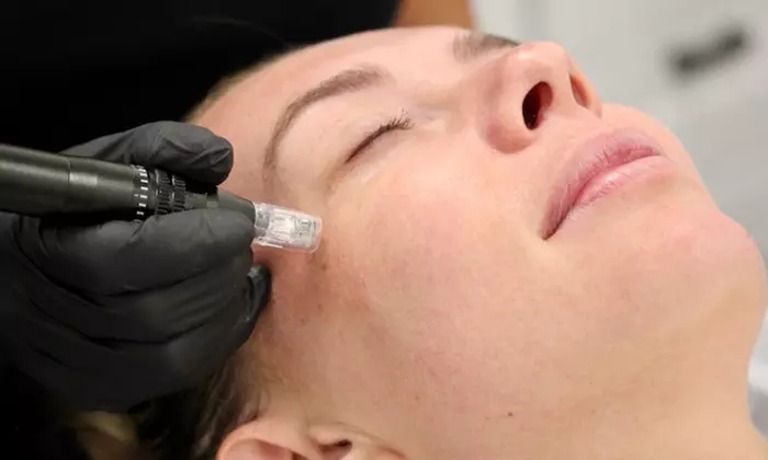 Up to 65% Off on Micro-Needling at Peach Skin & Laser - Tempe