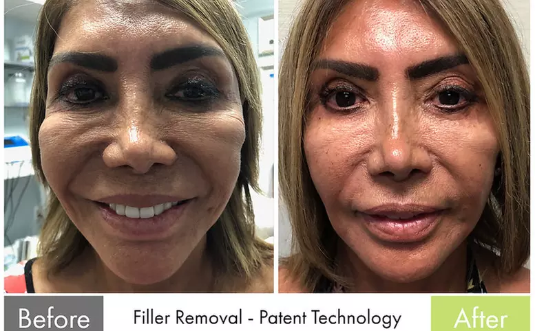 Up to 50% Off on Cavitation at Facelift Med Spa - Primary Image