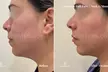 Up to 64% Off on Ultherapy / Ultrasonic Facial at One Beauty Aesthetics - Second Medium