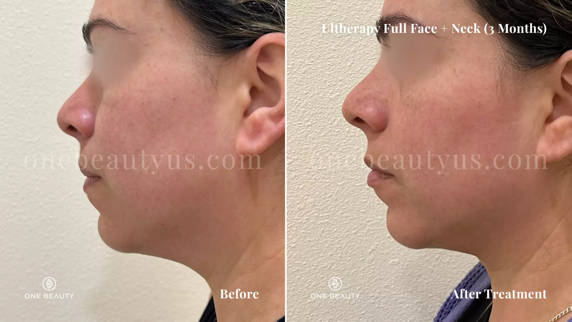 Ultherapy / Ultrasonic Facial at One Beauty Aesthetics