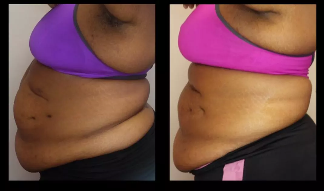 Ultrasonic Body Sculpting Sessions for a Slimmer You